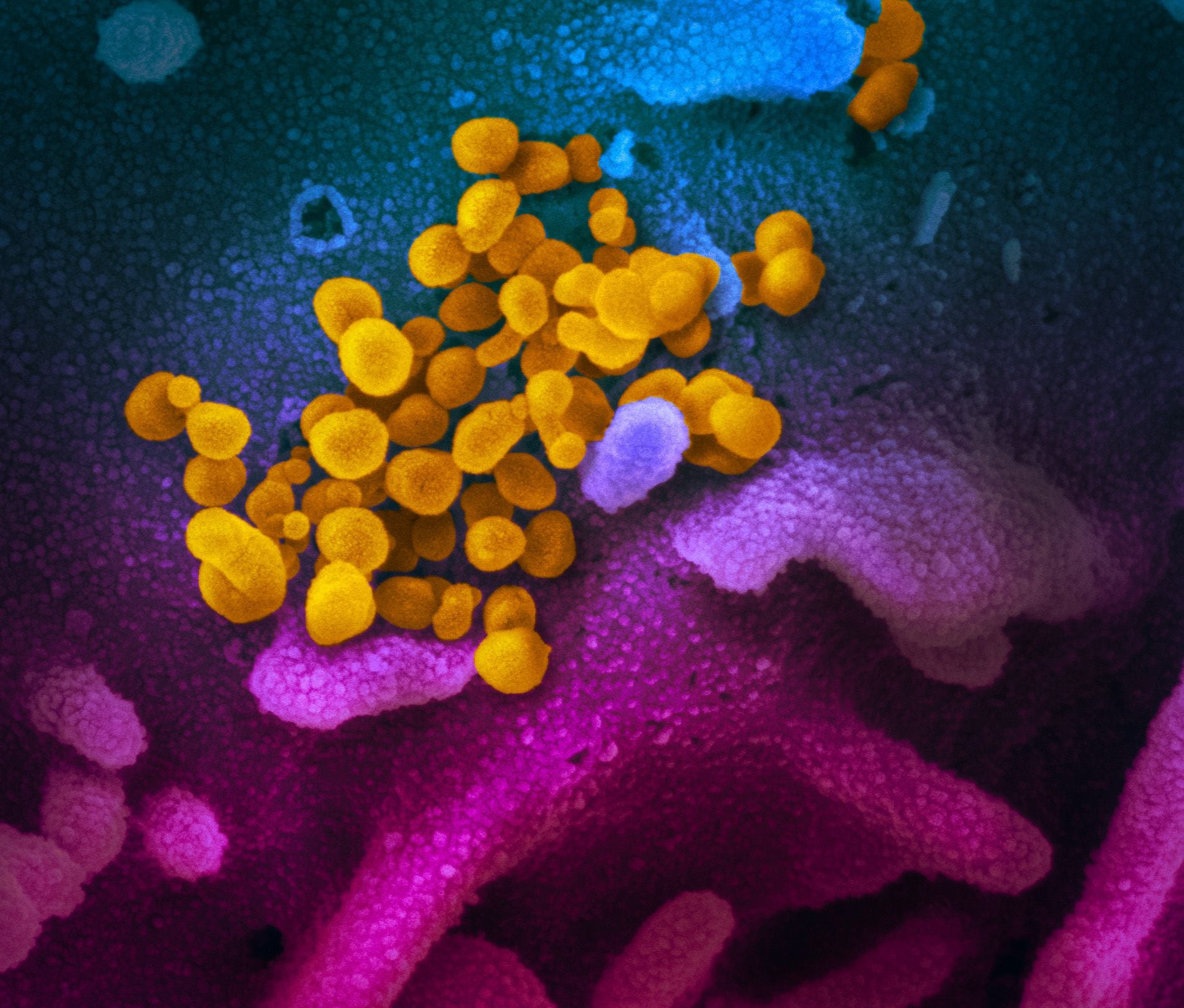 This scanning electron microscope image shows SARS-CoV-2 (yellow)--also known as 2019-nCoV, the virus that causes COVID-19--isolated from a patient in the U.S., emerging from the surface of cells (blue/pink) cultured in the lab.CREDITNIAID RML
