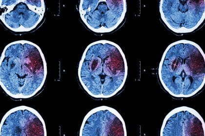 De acuerdo con varios otros informes, el riesgo de eventos cerebrovasculares (accidente isquémico y hemorragia intracraneal) se elevó después del COVID-19 (Shutterstock)