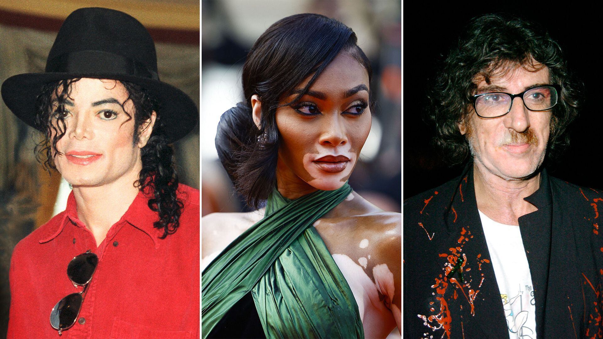 los famosos que padecen vitiligo