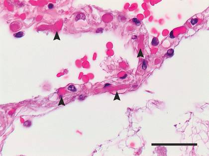 Microtrombos en pulmones por COVID-19 (NEJM)