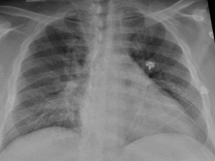 La radiografía de tórax de un paciente positivo de COVID-19 que muestra una neumonía en la parte inferior de los pulmones.
SALUD
RADIOLOGICAL SOCIETY OF NORTH AMERICA

