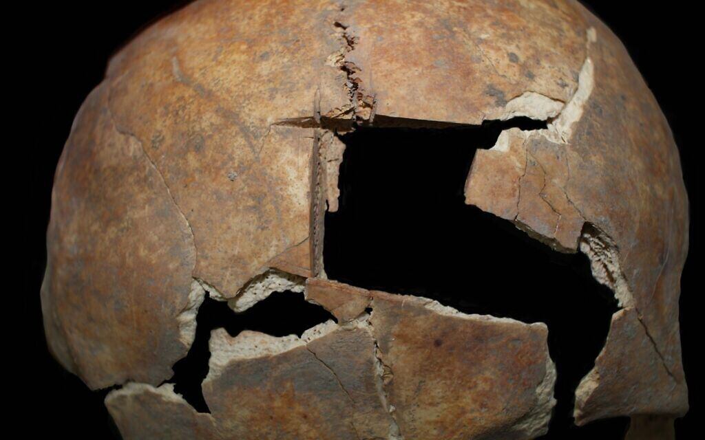 A close view of the trephination procedure discovered at Tel Megiddo in northern Israel and the piece of the skull that was removed. (courtesy Rachel Kalisher)