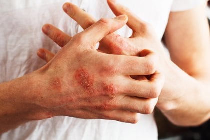 En el país, se estima que hay 800.000 personas que tienen psoriasis (Shutterstock)