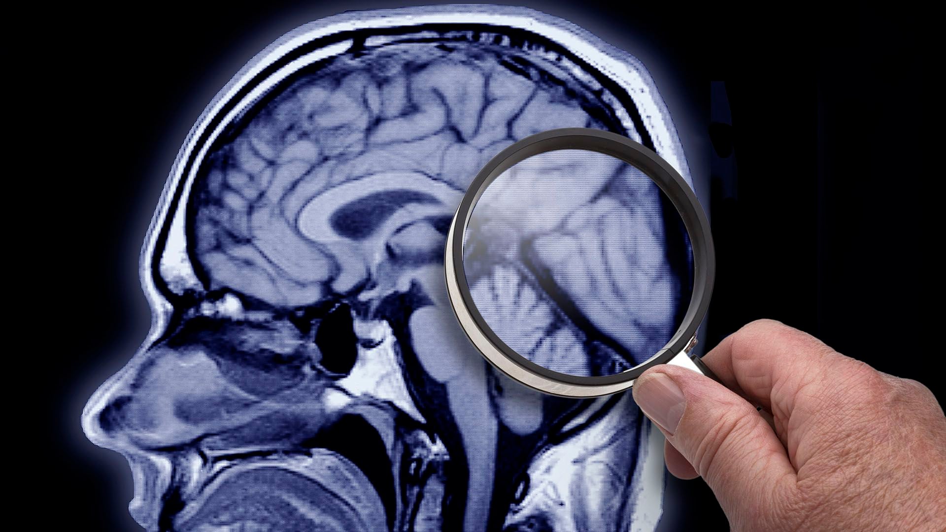 Aún se necesitan ensayos clínicos para evaluar a más pacientes con los implantes cerebrales
(Getty Images)