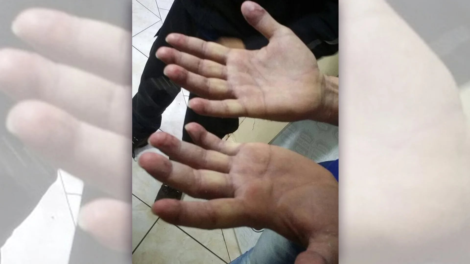 Imagen de las manos de Pérez Corradi, con visibles lesiones en las yemas de los dedos