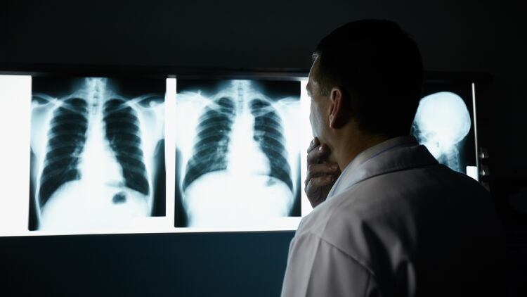 La neumonía que se observa en imágenes no es la típica con pus en el pulmón sino que es una neumonía inflamatoria que por alguno de los mecanismos descriptos causa la hipoxia (Shutterstock)