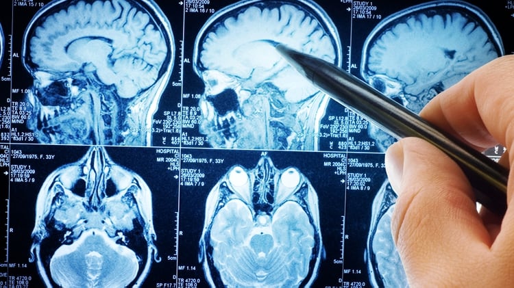 La investigación asegura que comparar escaneos cerebrales tomados a través del tiempo de un mismo paciente posibilitará diferenciar entre tejidos sanos y enfermos en el cerebro (Shutterstock)