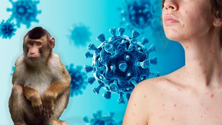 Viruela del mono: no se tardará mucho en declarar la pandemia