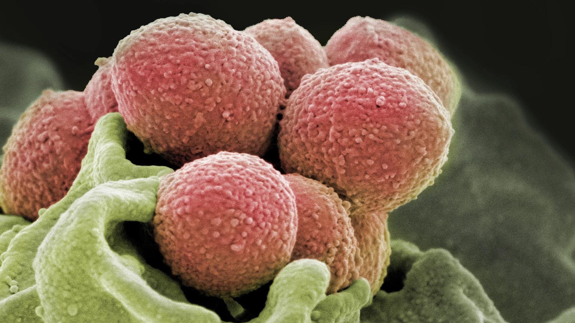 En algunos pacientes se pueden presentar infecciones más graves provocadas por la bacteria Streptococcus pyogenes. Son cepas con toxinas que causan infecciones invasivas/

NIH National Institute of Allergy and Infectious Diseases (NIAID)