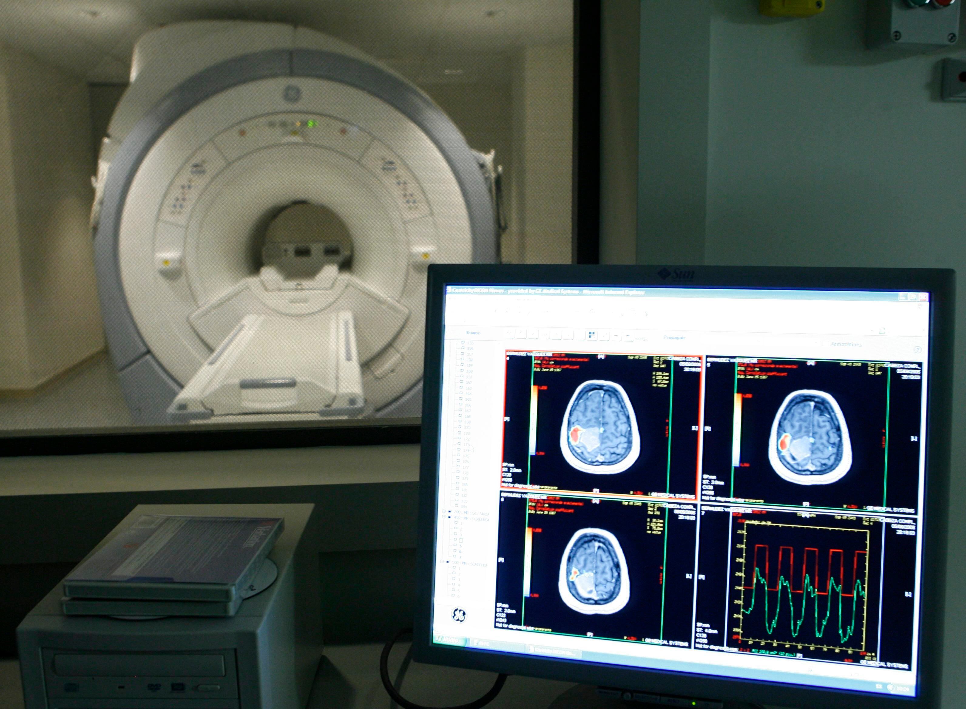 Descubren una nueva alteración en el cerebro de las personas con Alzheimer (EFE)