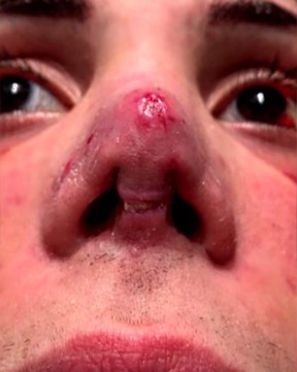 La nariz infectada de Felipe Pettinato (Foto: Ángel De Brito)
