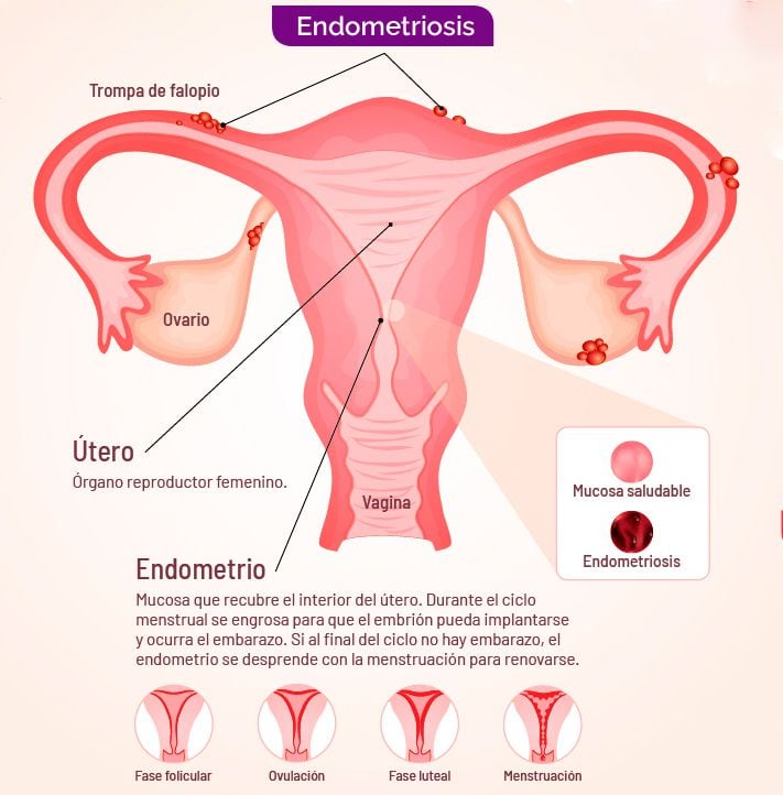 A livello globale, si stima che 1 donna su 10 soffra di endometriosi