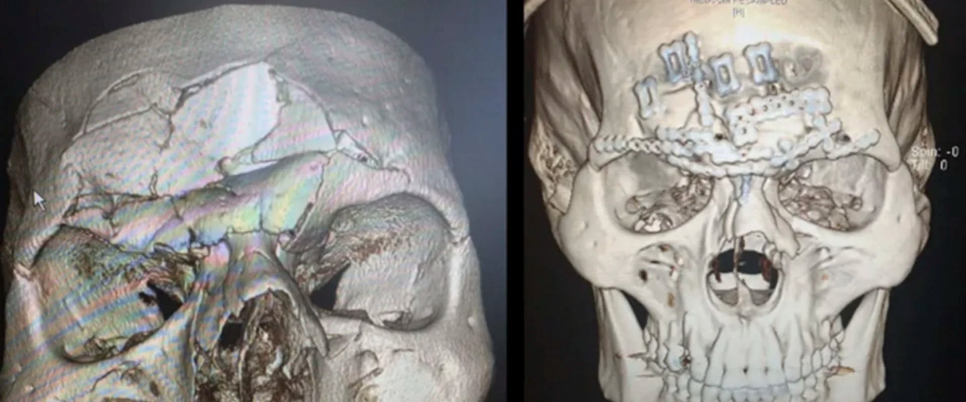 El antes y el después: las radiografías del peleador