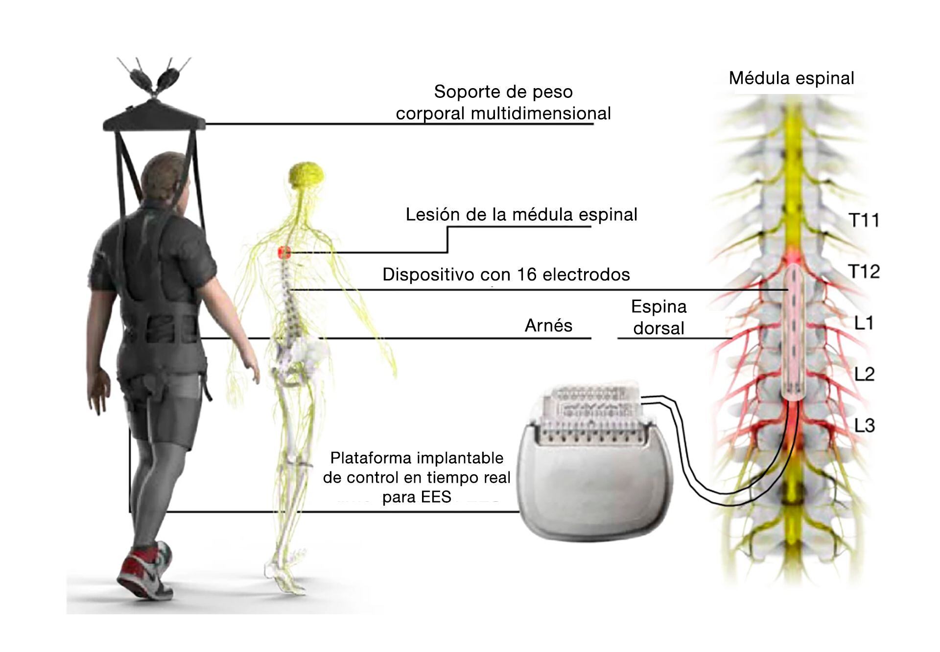 Estimulación de alta frecuencia de la médula espinal: nuevo