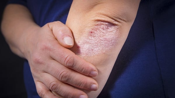 Esta es una enfermedad crónica, inflamatoria y sistémica que se caracteriza por producir lesiones cutáneas rojizas que descaman (Getty)