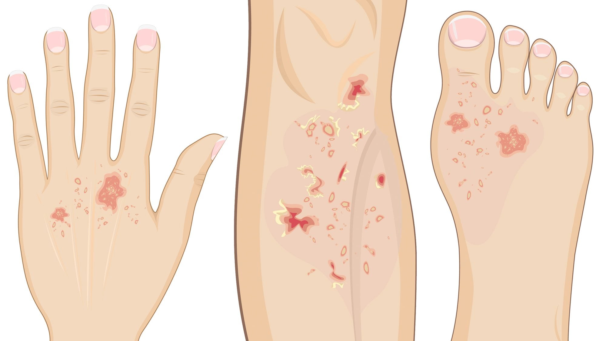 Los síntomas de lepra incluyen lesiones cutáneas que son más claras que el color normal de la piel. También cuando hay disminución de la sensibilidad al tacto, al calor o al dolor/Archivo