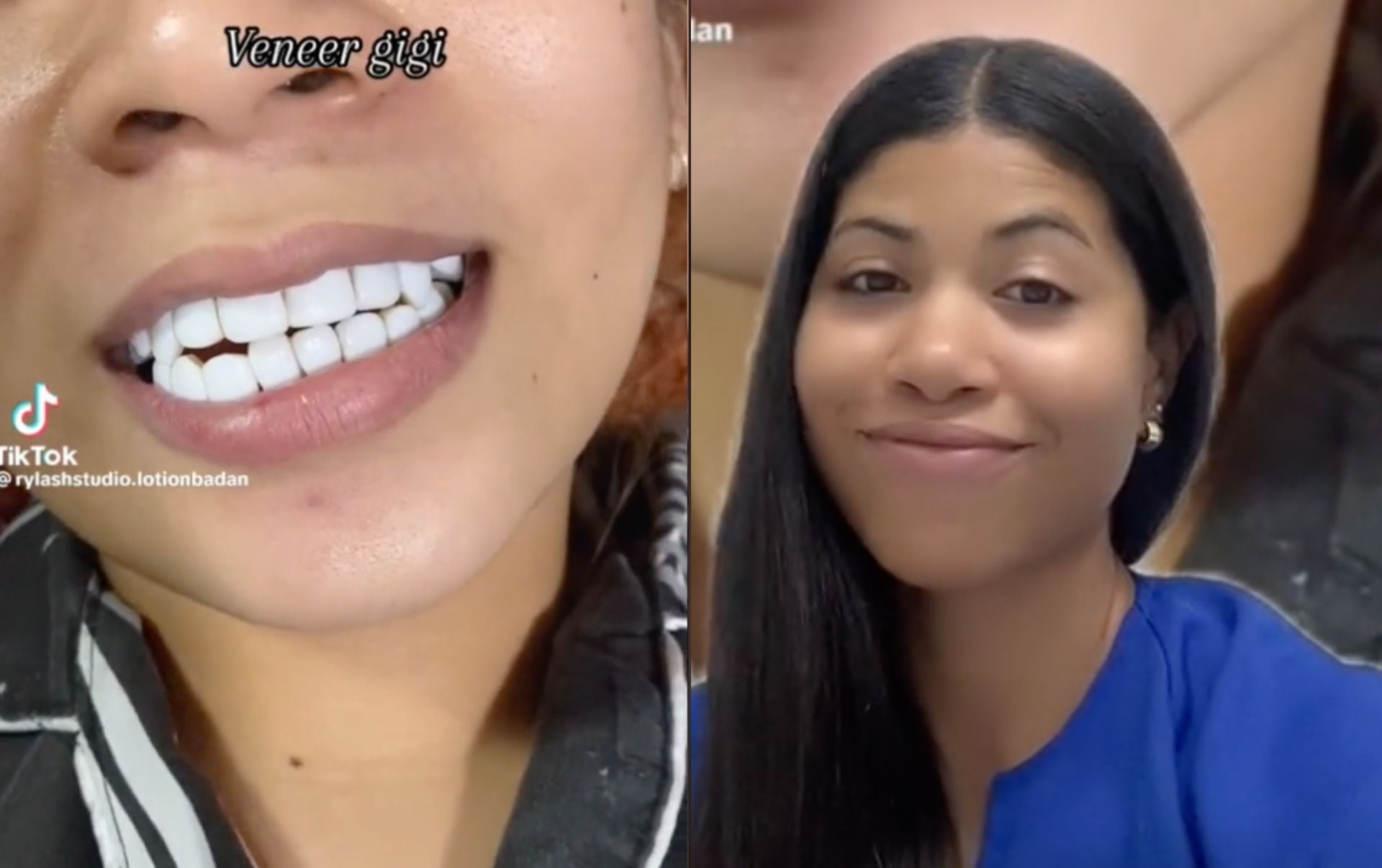 Mujer Se Pone Carillas Dentales En Un Salón De Pestañas Y Sale Mal Así Reaccionaron Los 