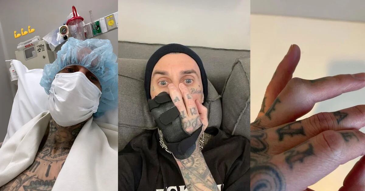 Travis Barker sparked concerns over finger surgery weeks after performing in Mexico