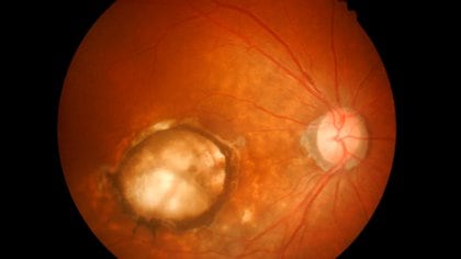 Se considera “ciega legal” a una persona cuya agudeza visual (con gafas o lentes de contacto, si las necesita) es diez veces menor de lo normal en su mejor ojo (Shutterstock)