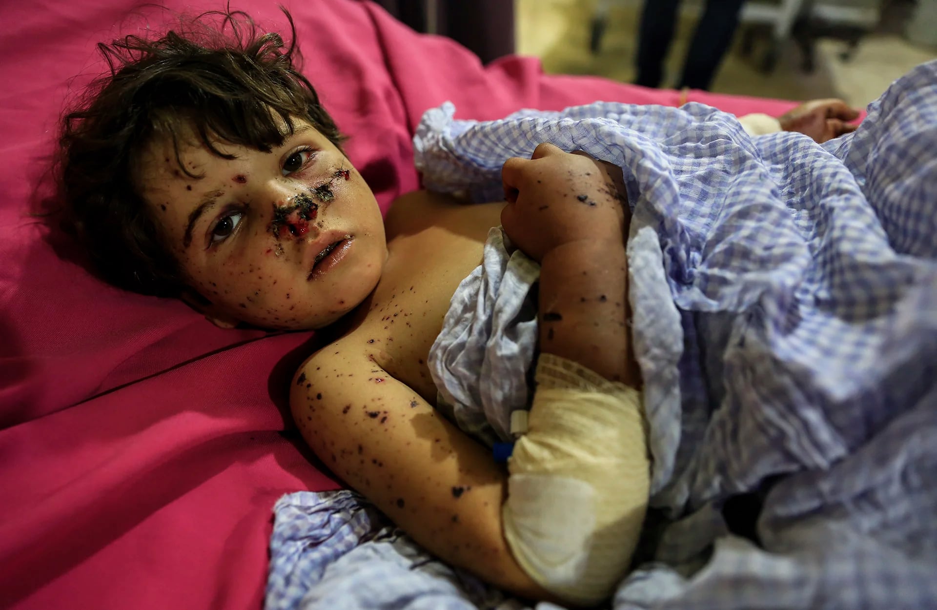 Una niña siria de cinco años de edad en un hospital el 21 de julio tras resultar herida por un bombardeo de las fuerzas de Bashar al Assad en el pueblo de Al Rehan, cerca de Duma, una ciudad controlada por los rebeldes al este de Damasco (AFP)