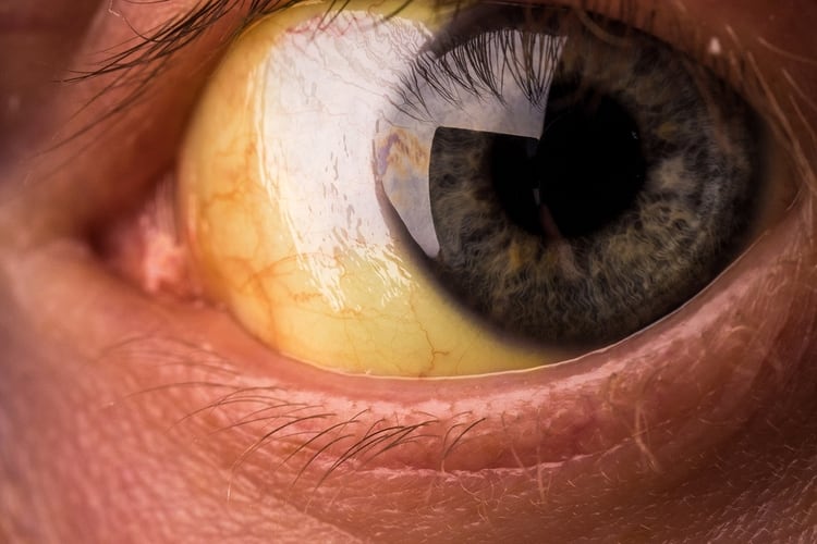 La coloración amarilla de la piel y la parte blanca de los ojos, conocida como ictericia, es uno de los principales síntomas de la hepatitis tóxica (Shutterstock)