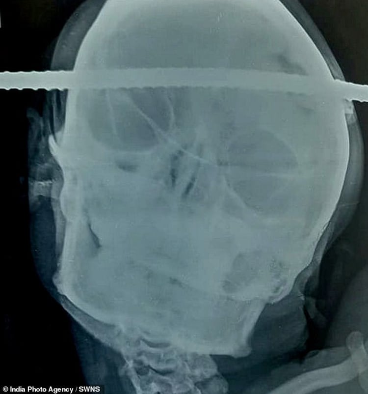 La radiografía del cráneo de Bahe