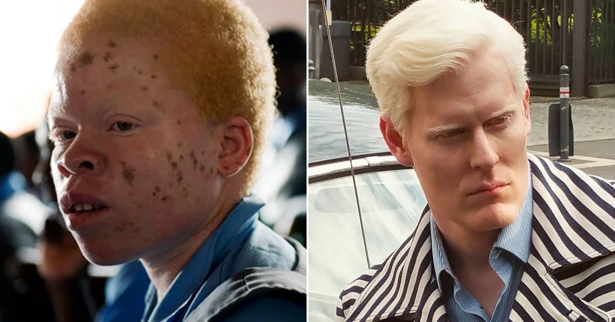 Ser albino: en África puede llevar a una horrible muerte, en Europa y  América a ser una estrella de la moda - Infobae