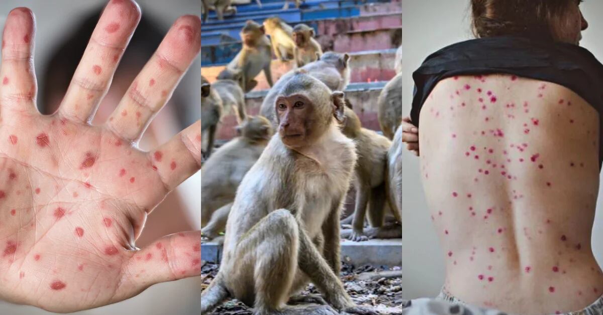 Monkeypox: What are the health warnings issued in Peru?