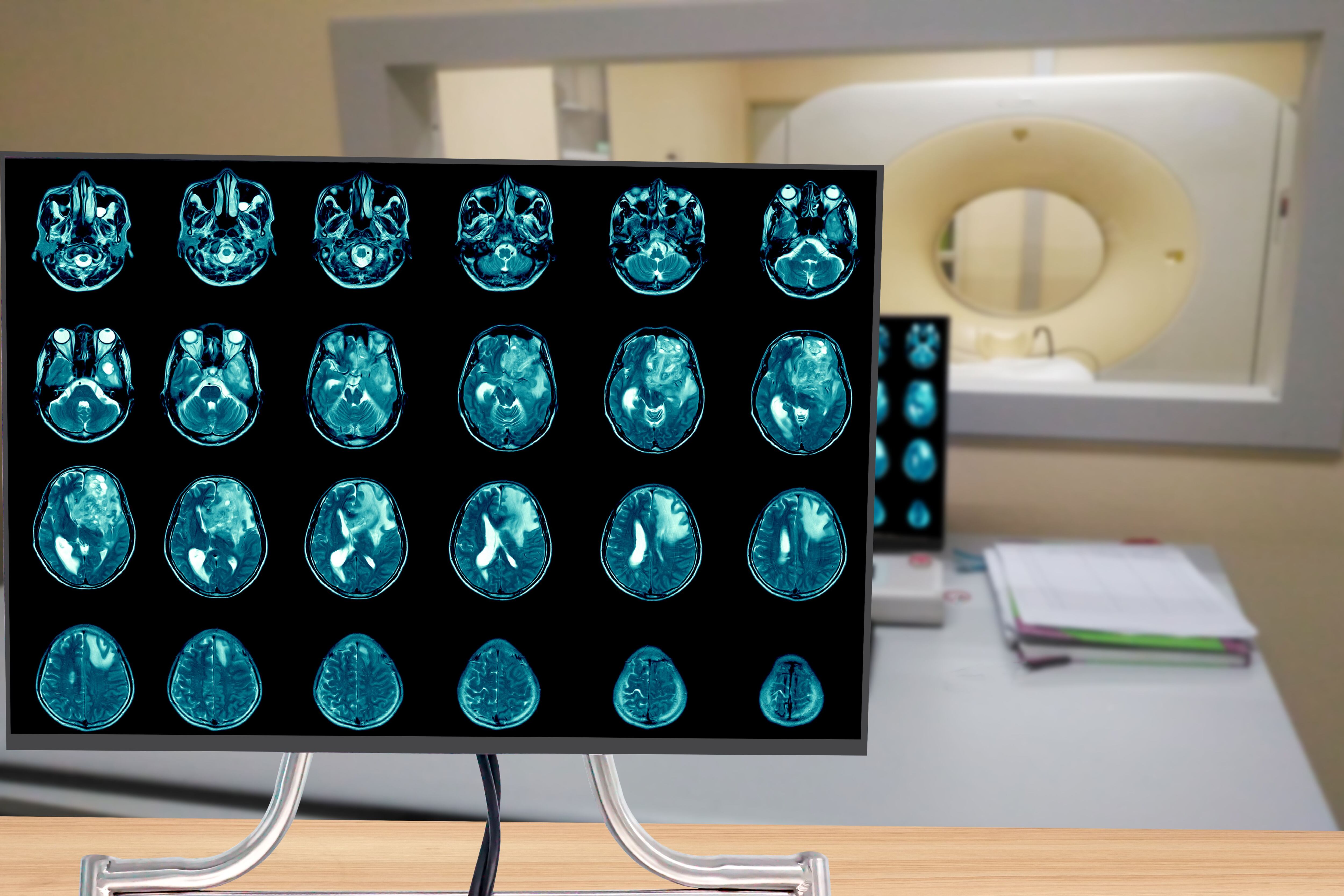 Imagen de una resonancia magnética del cerebro (Shutterstock)