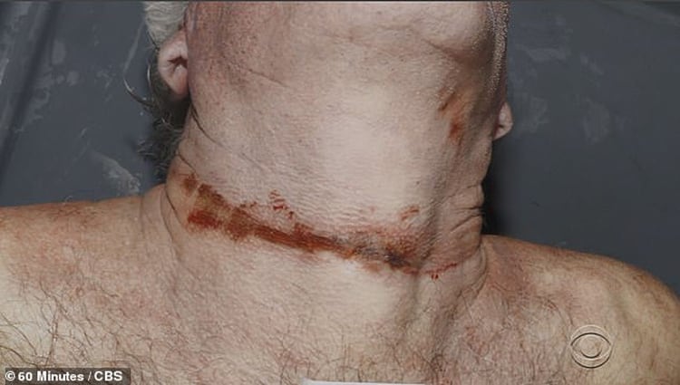 El cuello de Jeffrey Epstein y la marca de la cuerda que terminó con su vida (Gentileza 60 Minutes/CBS)