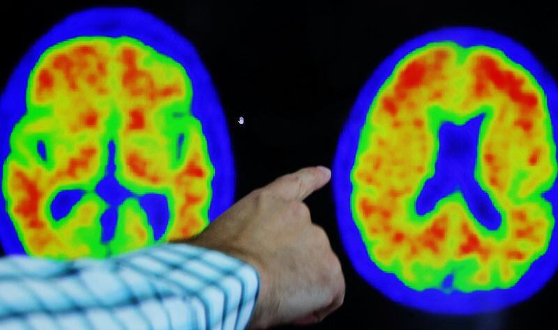El riesgo de enfermedades neurodegenerativas como Alzheimer o Parkinson podría prevenirse con el ejercicio /REUTERS/Brian Snyder