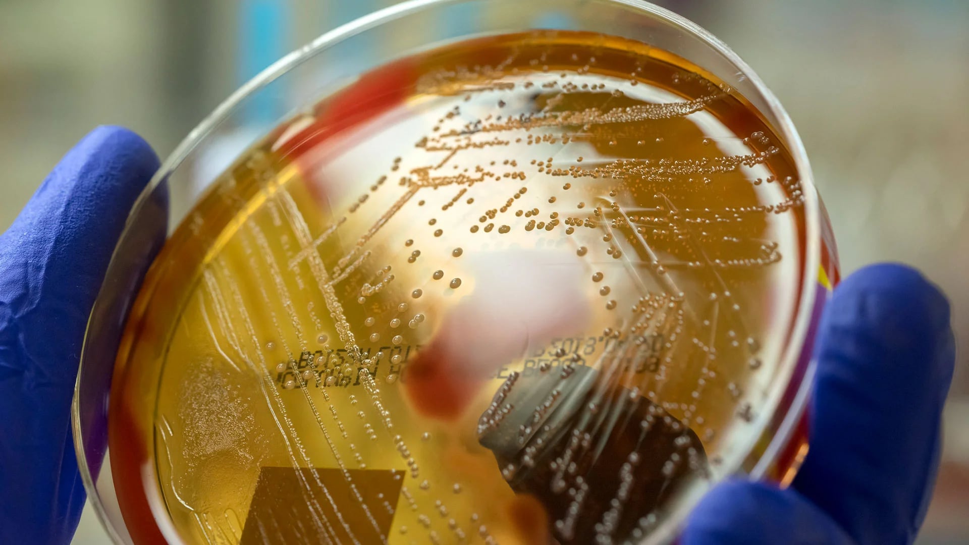 La faringitis se diagnostica mediante cultivos bacterianos y se trata con antibióticos. La higiene de las manos y la higiene personal pueden ayudar a controlar la transmisión (Gettyimages)