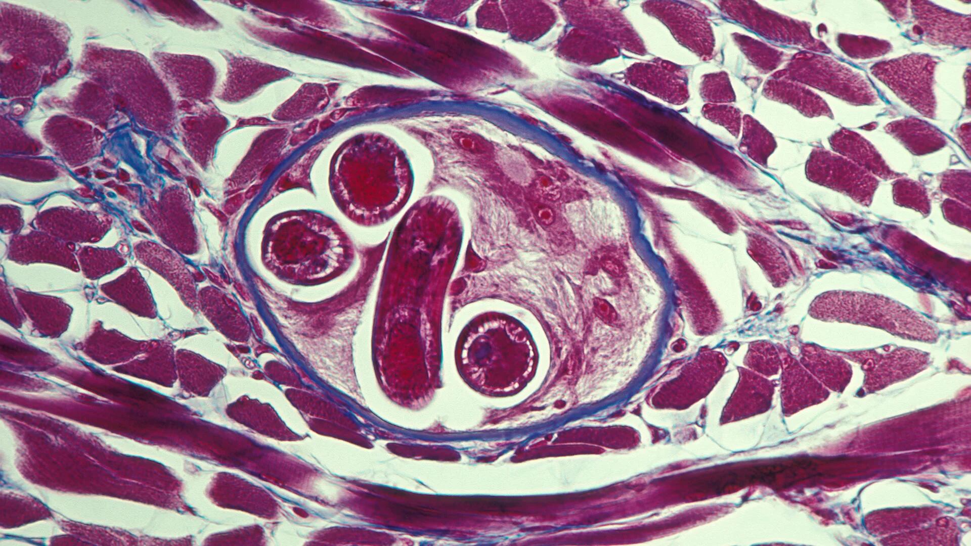 La triquinosis o trichinellosis es una enfermedad parasitaria que se transmite al consumir carne infectada con larvas del parásito del género Trichinella spp.  (Getty)