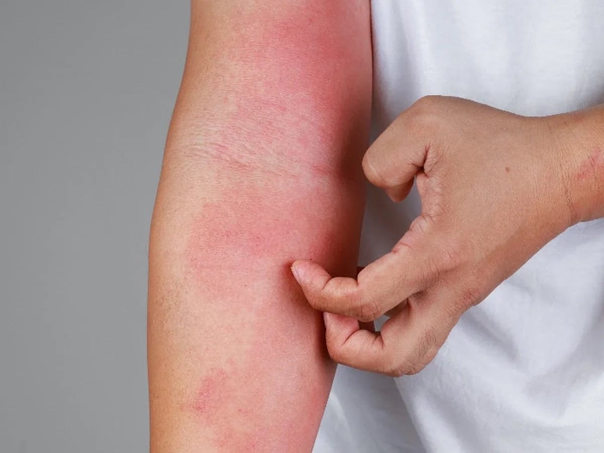 Dermatitis Atópica: de qué se trata la enfermedad crónica de la piel que a 1 cada 10 argentinos - Infobae
