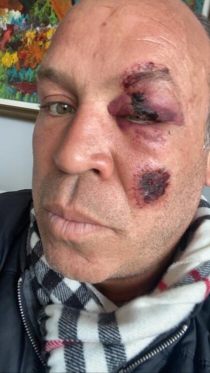 Wanderlei Silva mostró las heridas de su rostro en las redes sociales (@wandfc)