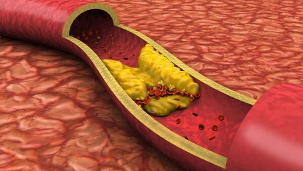 La acumulación de placas de colesterol en las arterias puede generar una obstrucción y posterior infarto