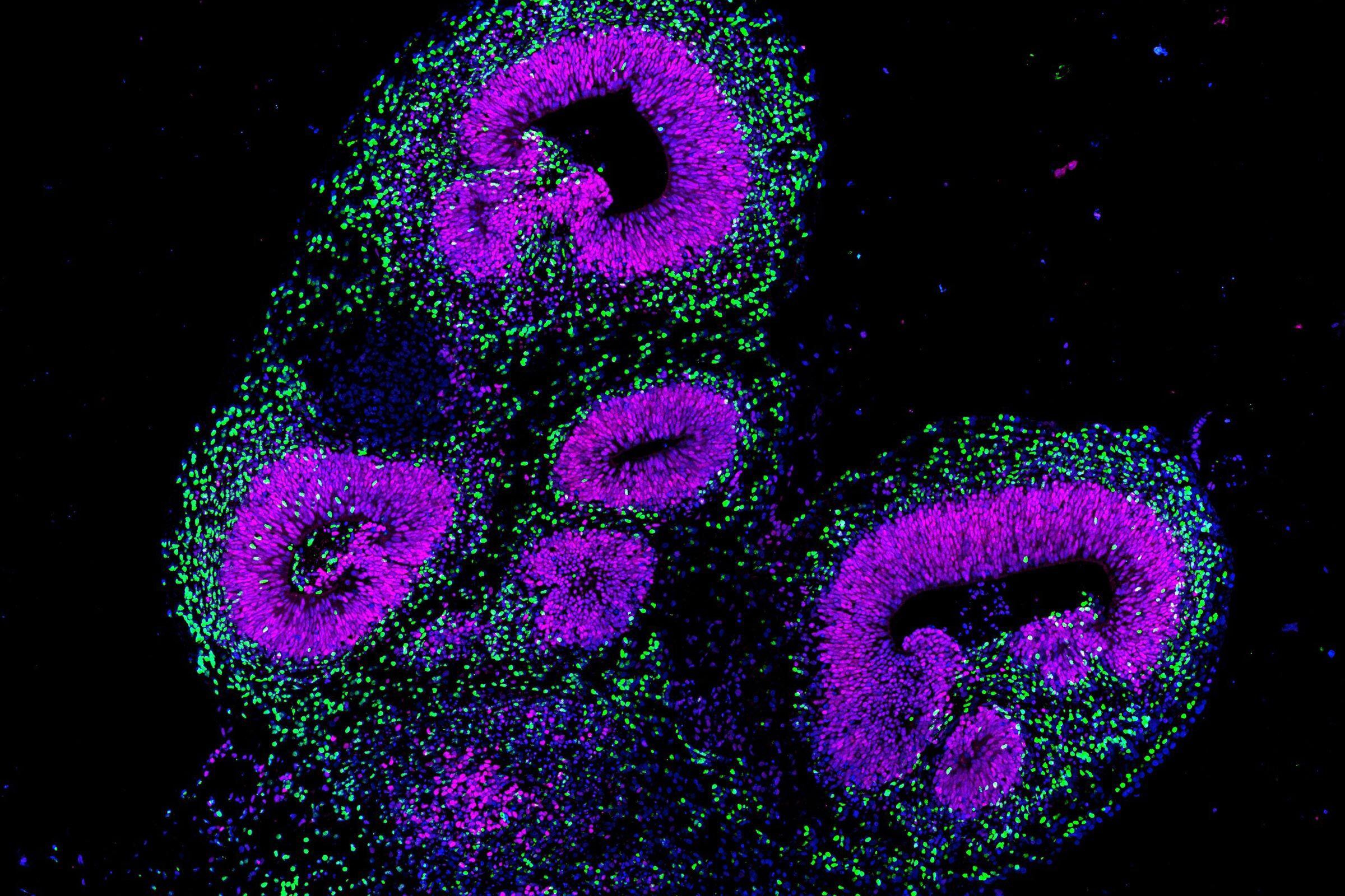 Brain organoid from human stem cells under the fluorescence microscope: the protein GLI3 is stained purple and marks neuronal precursor cells in forebrain regions of the organoid. Neurons are stained green.CREDITPhotograph: F. Sanchís Calleja, A. Jain, P. Wahle / ETH Zurich