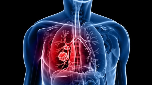 El cáncer de pulmón es uno de los más letales, especialmente si se diagnostica tardíamente (Getty)