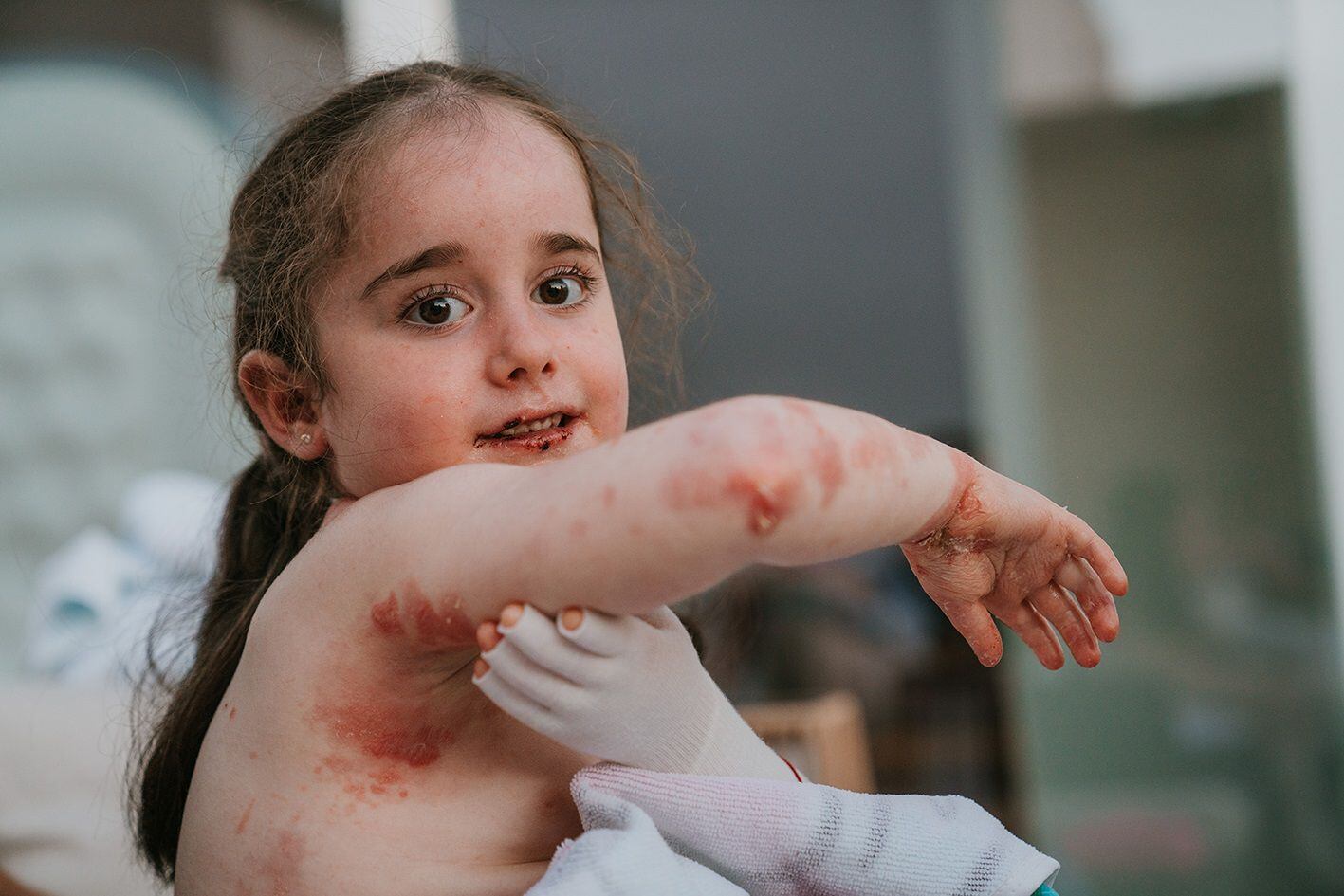 Una niña afectada por la enfermedad de piel de mariposa