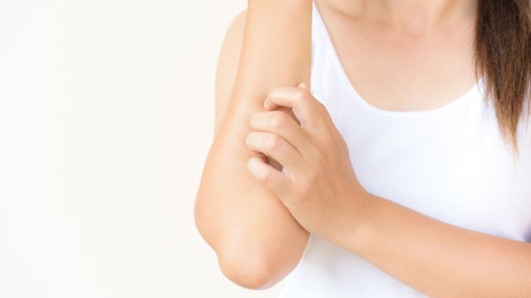 La dermatitis atópica es una enfermedad inflamatoria crónica -no contagiosa- que altera el sistema inmunitario (Shutterstock)