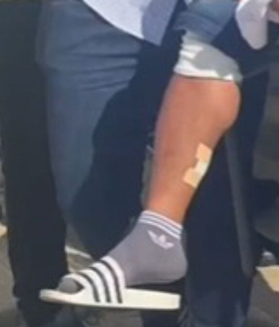 Luis Manuel Díaz y otra de las lesiones en su pierna derecha