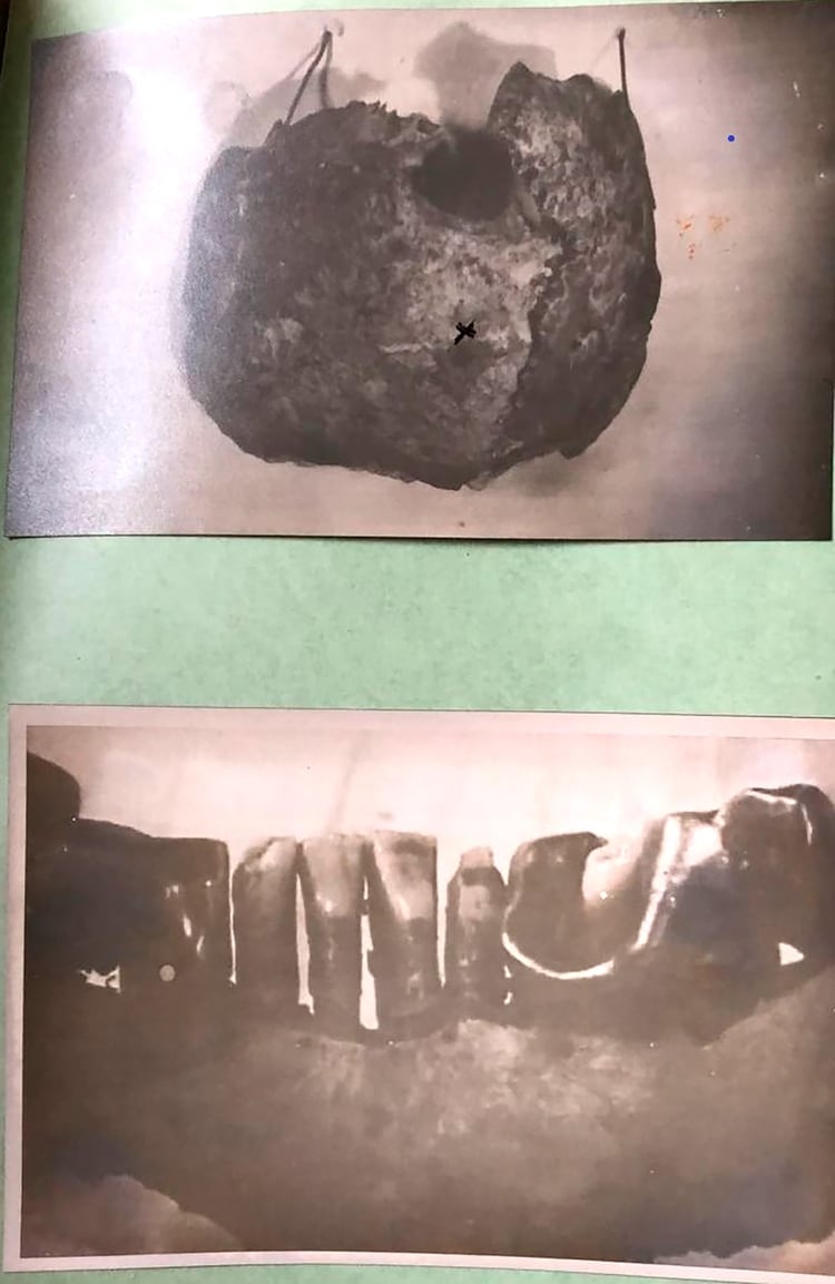 Fotos del crÃ¡neo de Hitler y un maxilar con restos de su dentadura fotografiados en la carpeta 