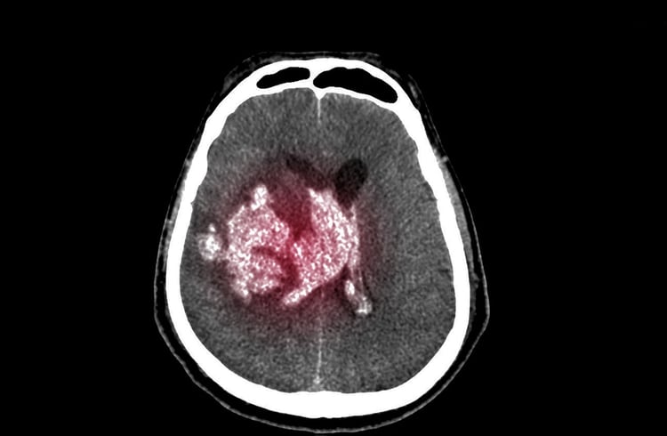 El hematoma subdural es una acumulación de sangre en el espacio que está entre las dos membranas que cubren el cerebro (Shutterstock)