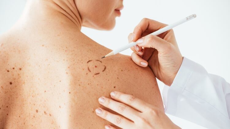 Detectado a tiempo, el cáncer de piel es curable en la mayoría de los casos (Shutterstock) 