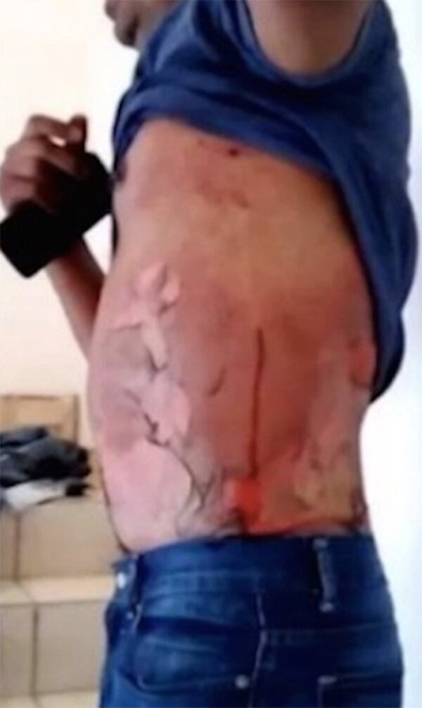 El hombre sufrió quemaduras leves en el torso (Foto: Facebook)