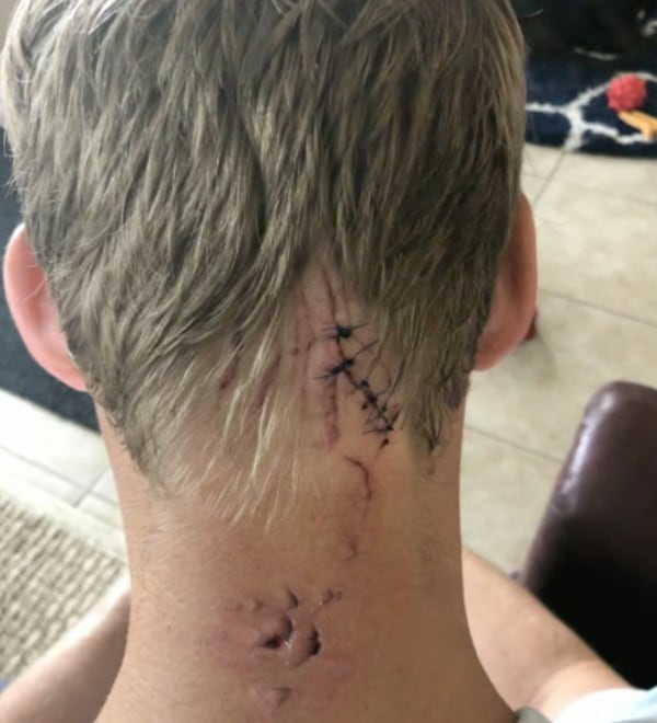 Así quedaron la sutura en la cabeza y las lesiones en el cuello después del ataque