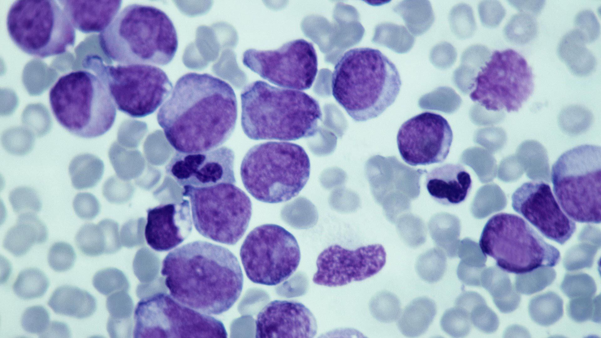 LEUCEMIA