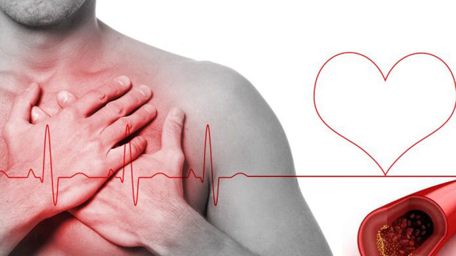 No existe un valor "normal" de colesterol LDL para todos; el nivel óptimo varía según el riesgo cardiovascular individual de cada persona