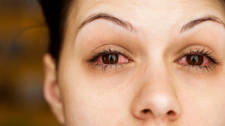 El tratamiento es el mismo que para cualquier conjuntivitis, no es un cuadro que revista gravedad para la vista (Shutterstock)