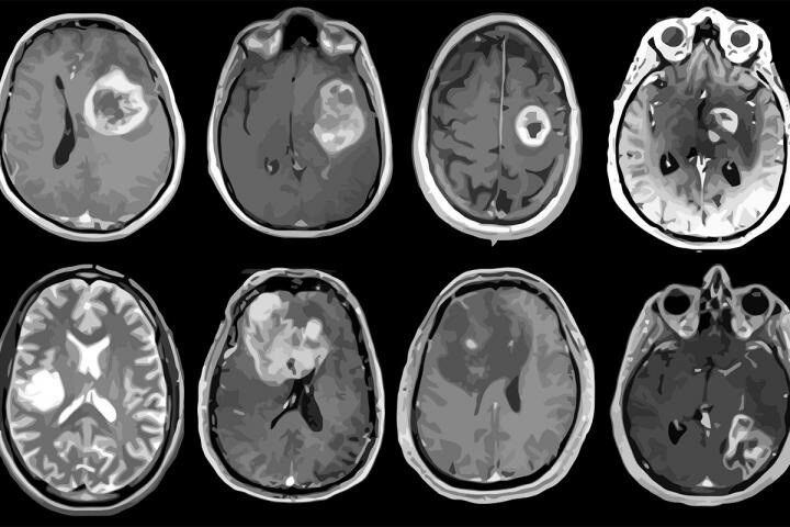 El tratamiento por Captura Neutrónica en boro y la protonterapia son esperanzas para pacientes con cáncer cerebral para el futuro/Archivo